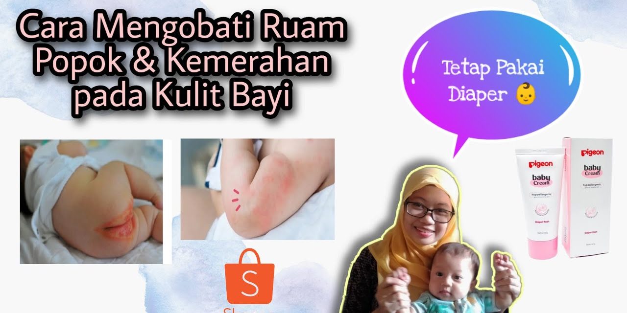 Waspada Ruam Popok Pada Bayi, Ini Cara Pelindung Kulitnya